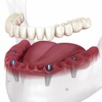 Complete Guide to Dental Implants: Benefits, Procedures, and Choosing the Best Dental Tooth Implant