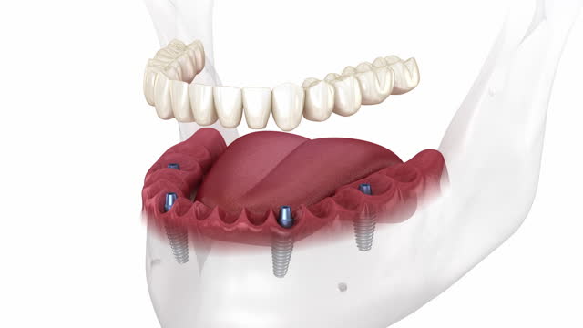 Complete Guide to Dental Implants: Benefits, Procedures, and Choosing the Best Dental Tooth Implant