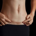 mini abdominoplasty