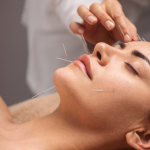 Best Cosmetic Acupuncturist