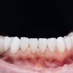 Cracked Tooth Naturally